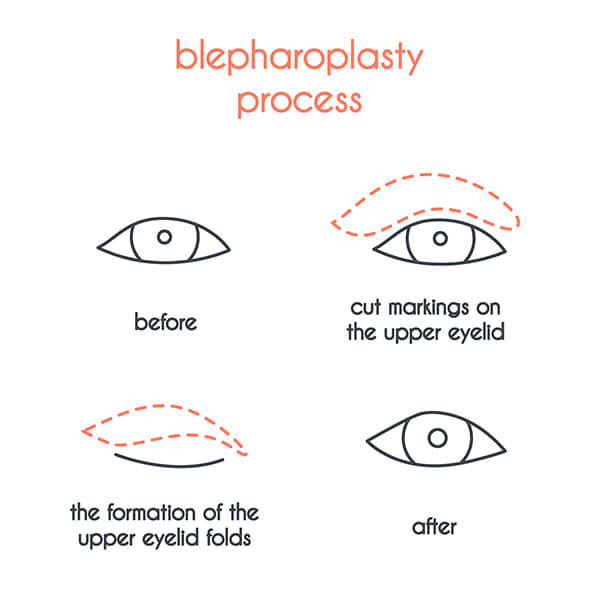 Blepharoplasty Procedure diragram