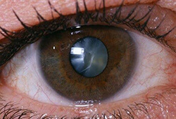 close up of cataracts in an eye