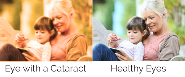 eye with cataracts versus eye after cataract surgery