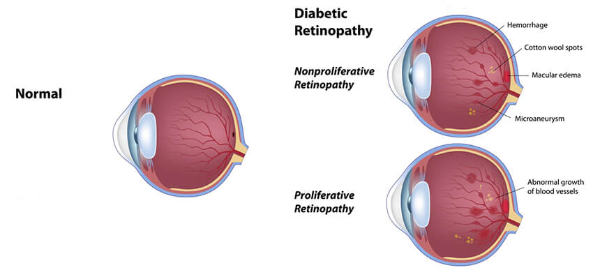 Diabetic Retinopathy Diagram