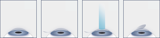 LASIK Eye Surgery Procedure