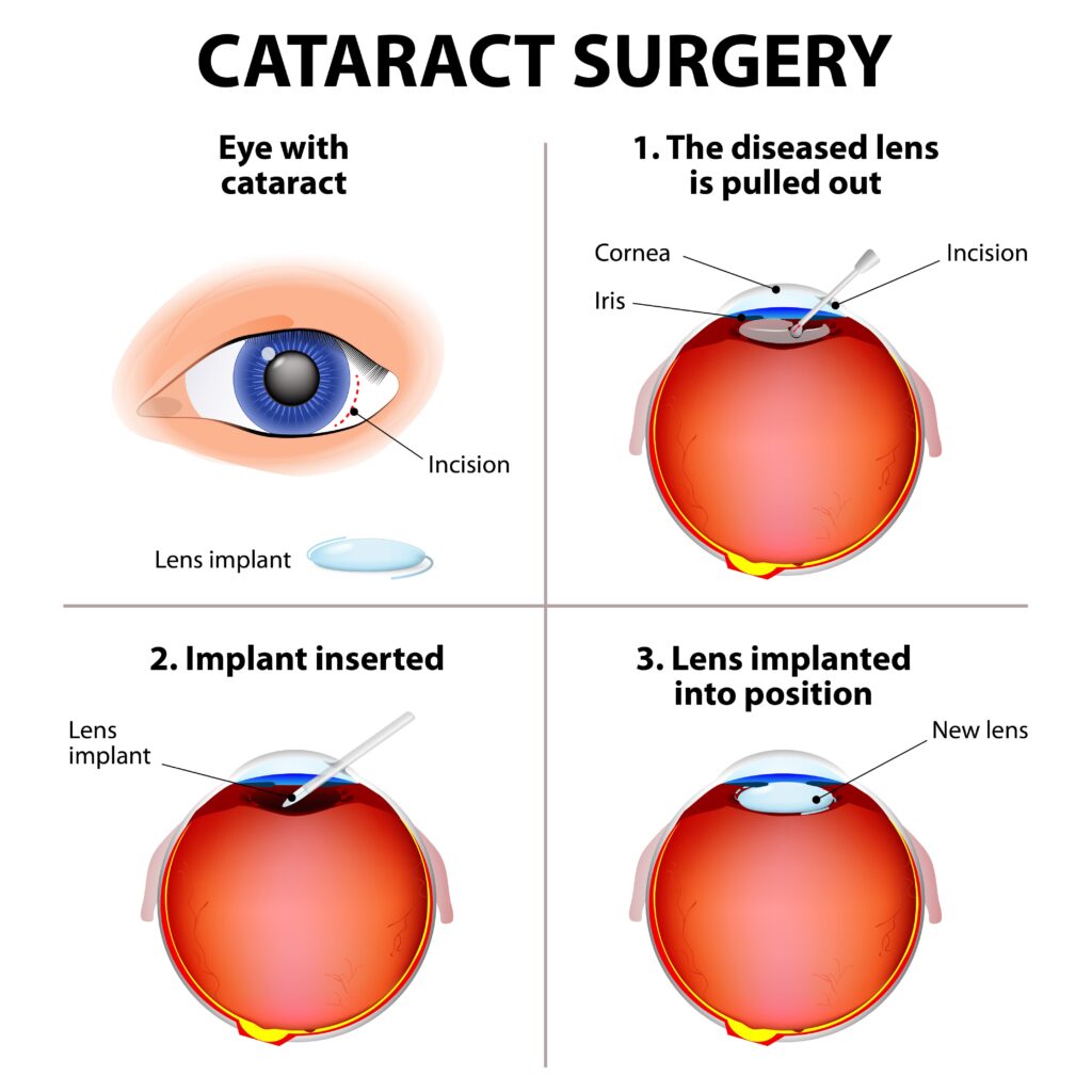 diagram of cataract surgery
