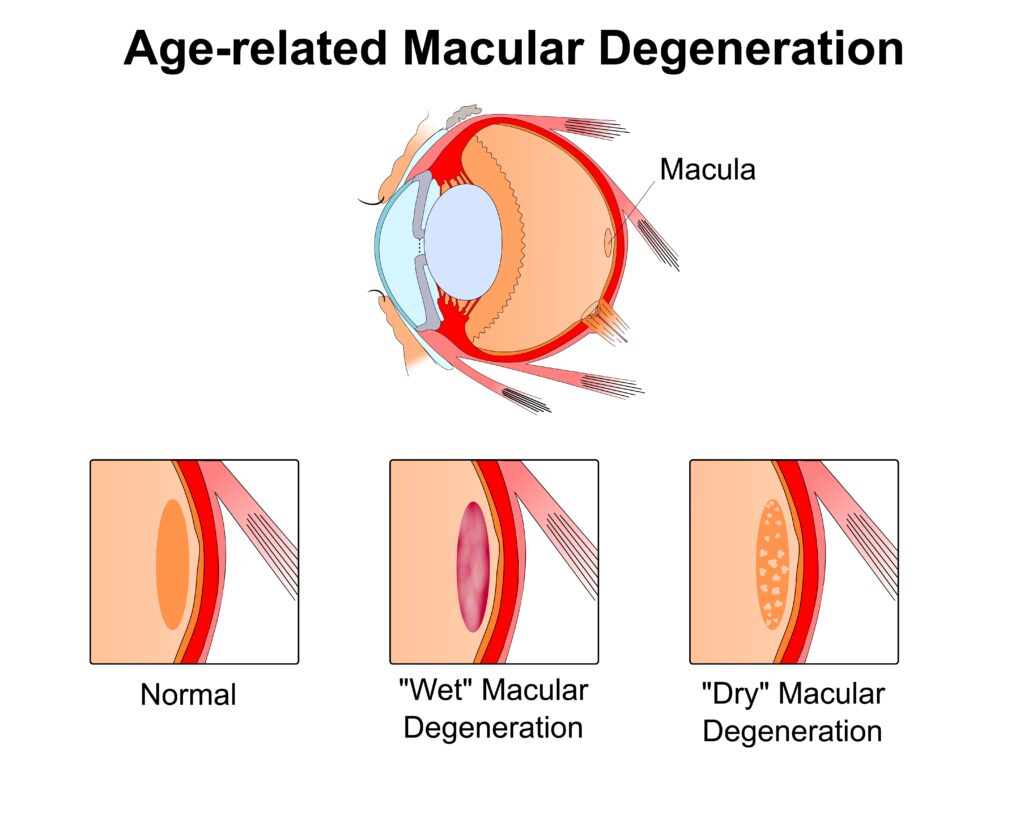 Macular Degeneration Troy Eye Exam Troy Greenberg Eye macular-degeneration-troy-eye-exam-troy-greenberg-eye