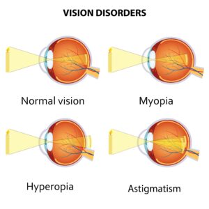 mi a myopia hyperopia)