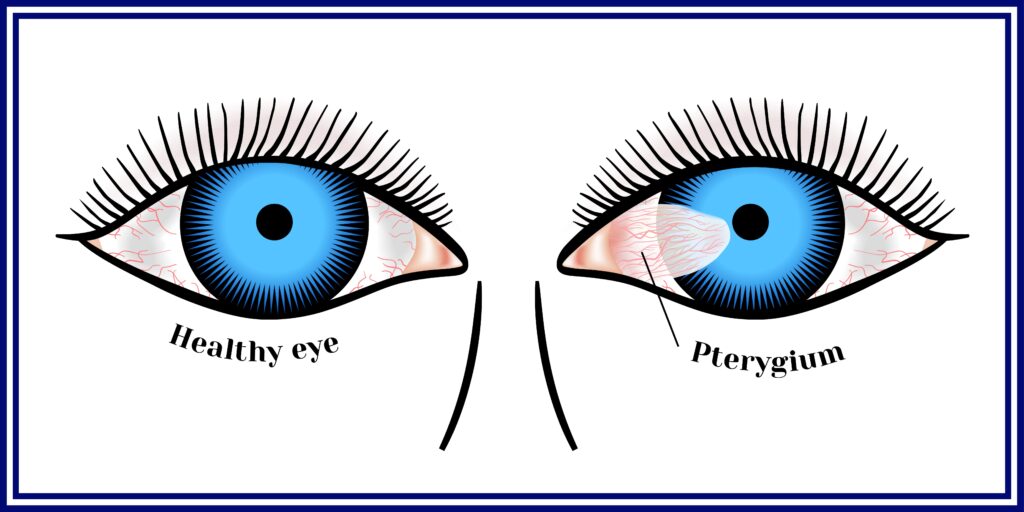 Diagram of health eye versus eye with a pterygium