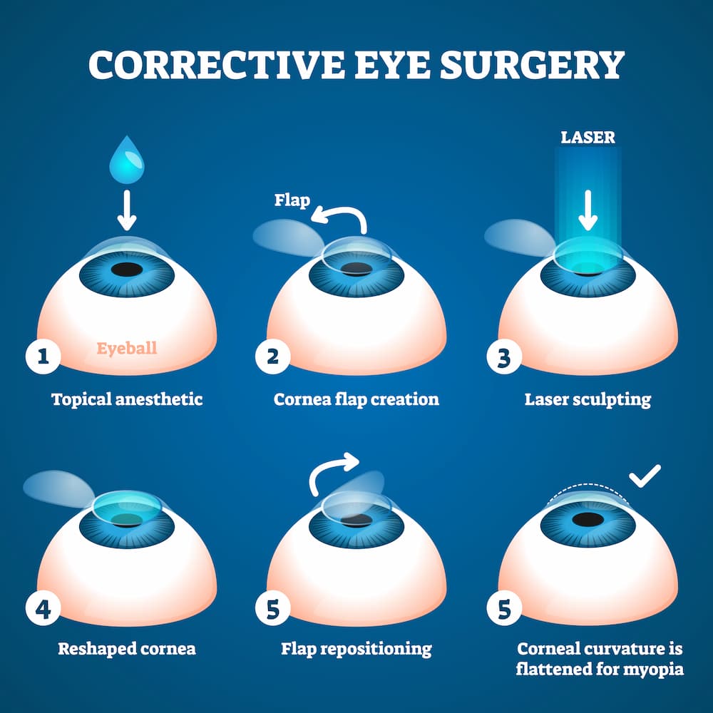 corrective eye surgery infographic