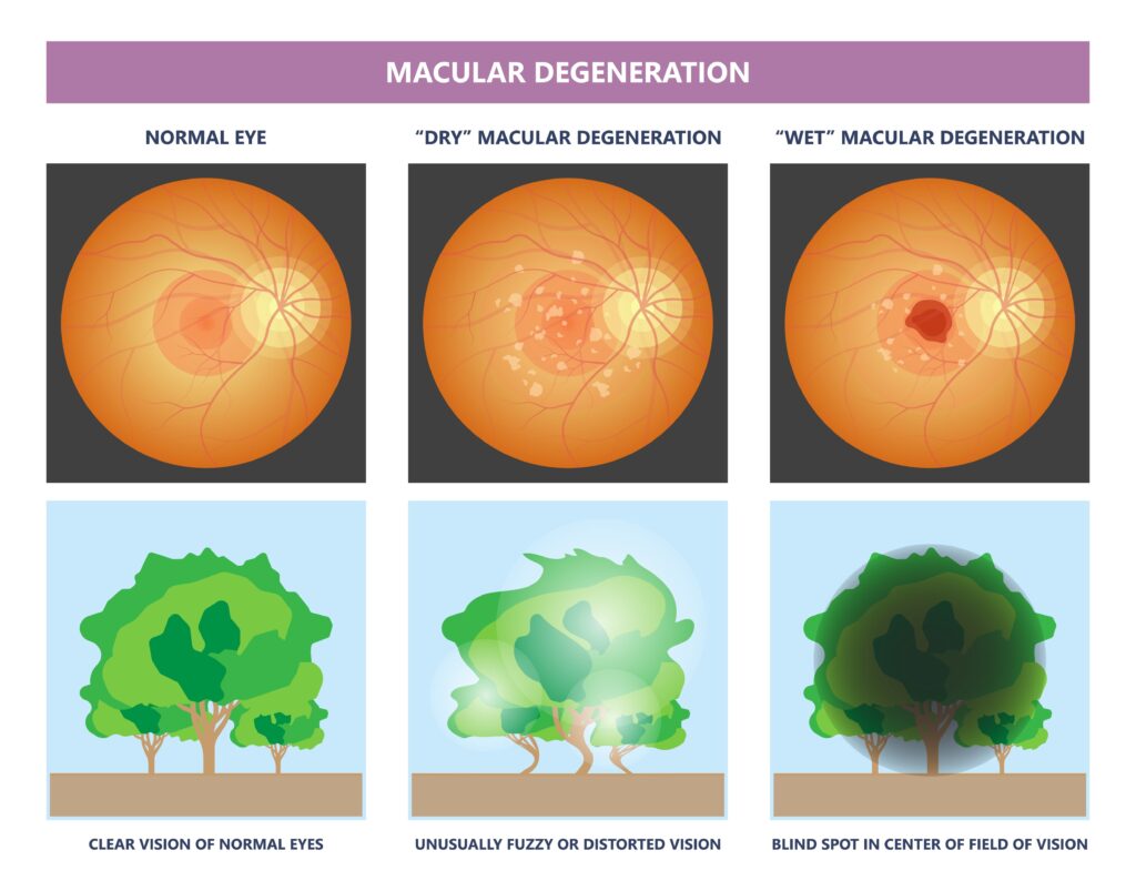 Macular Degeneration comparison photos